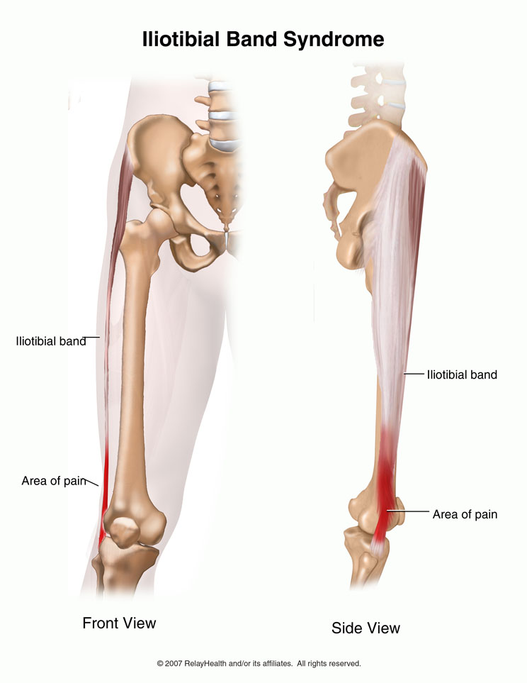 Iliotibial Band Syndrome: A real pain in the knee!