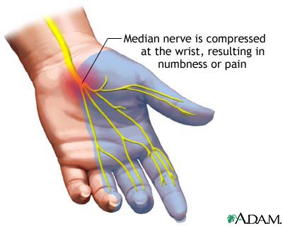 Carpal Tunnel Syndrome Treatment, bloomington il chiropractor