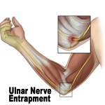 Ulnar Nerve Floss - Stop the tingling in your pinky finger Chiropractor ...