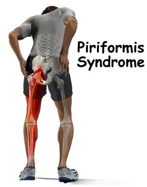 bloomington il chiropractor, chiropractor bloomington il, piriformis syndrome