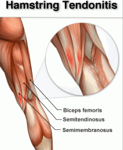 Hamstring muscle pain